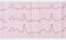 Tape ECG with macrofocal myocardial infarction and ventricular p