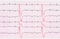 Tape ECG with ventricular premature beats (quadrigemini)