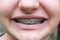 Teen braces close up smile