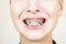 Teen with braces on his teeth.