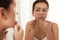 Teen girl with acne problem squeezing pimple near mirror