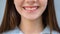 teen Smile with colorful Braces - correct bite. Orthodontic Treatment. Dental Care Concept. girl Healthy Smile close up. Ceramic