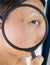 A teenage asian girl with acne problem visits a dermatologist, close-up. Skin under a magnifying glass