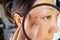 A teenage asian girl with acne problem visits a dermatologist, close-up. Skin under a magnifying glass