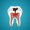 Teeth caries in cutaway