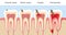 Teeth Caries Stages Pulpitis Periodontitis Enamel Caries