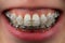 Teeth with ceramic and metal braces closeup