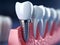 Teeth with dental implant. Generative AI