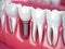 Teeth with dental implant. Generative AI