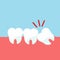 Teeth and gum problems. Impacted wisdom tooth for dentistry and dental surgery in flat style vector illustration