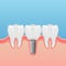 Teeth implant