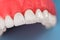 Teeth implant and crown installation process parts isolated on a blue background. Medically accurate 3D model.