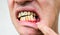Teeth implantation. Dental post preparation. Medical problem