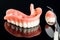 Teeth model showing an implant crown bridge model.