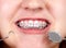 Teeth with orthodontic brackets.