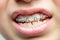 Teeth with orthodontic brackets. Dental health care