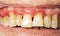 Teeth with periodontitis