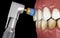 Teeth polishing procedure with professional brush and gel. Medically accurate