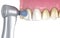 Teeth polishing procedure with professional brush and gel. Medically accurate 3D illustration