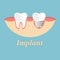Teeth procedure of implant restoration. Process stomatology prosthesis