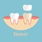 Teeth procedure of veneer restoration. Process stomatology prosthesis