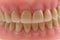 teeth prothesis background