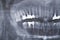Teeth x-ray image. Scan of teeth