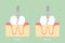 Teeth scaling - dental plaque removal, anatomy structure including the bone and gum