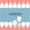 Teeth and smile makeover with dental ceramic veneers, row of foretooth before and after veneer cover
