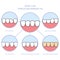 Teeth and smile makeover with dental ceramic veneers, row of teeth fixed with veneer cover, before and after teeth