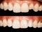 Teeth before and after treatment