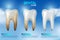 Teeth whitening 3d concept. Comparison of clean and dirty tooth before and after whitening