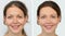 teeth whitening contrast pictures