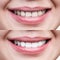 Teeth of young woman before and after whitening.