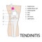 Tendinitis knee injury