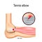 Tennis elbow or lateral epicondylitis.