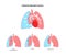 Tension pneumothorax poster