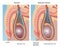 Testicular torsion