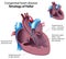 Tetralogy of Fallot