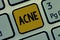 Text sign showing Acne. Conceptual photo Skin disease involving the oil glands at the base of hair follicles