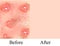 Texture, inflamed pimples and acne. Before After acne cysts. Skin background. Infographics. Vector illustration on