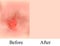 Texture, inflamed pimples and acne. Before After acne cysts. Skin background. Infographics. Vector illustration on