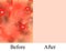 Texture, inflamed pimples and acne. Before After acne cysts. Skin background. Infographics. Vector illustration on