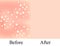 Texture, inflamed pimples and acne. Before After acne. Skin background. Infographics. Vector illustration on isolated