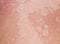 Texture of irritated reddened skin with flaking scales of dead old cells after sunburn and allergies on the human body