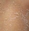 Texture of irritated skin with cracks of dead cells and redness after sunburn and allergies on the human body. Skin care concept