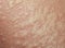 texture unhealthy irritated human skin is covered with fine wrinkles ,cracked and blistered from the burn and