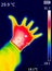 thermographic image of a person`s hand showing different temperatures in different colors, from blue indicating cold to red