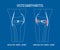 Thin Line Osteoarthritis Healthy and Unhealthy Knee. Vector