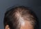 Thinning or sparse hair, male pattern hair loss